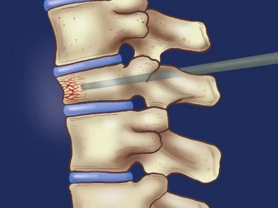 SIR-vertebroplasty-2-255
